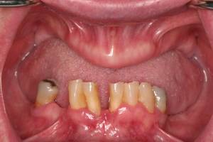 severe atrophic ridges due to loss of function and wear of removable dentures