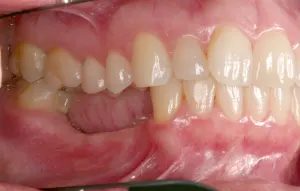 left side of the patient's dentition