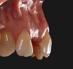 the patient lost his central incisor due to trauma
