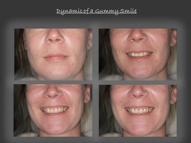 Before and After Crown Lengthening performed by Dr. Gallez