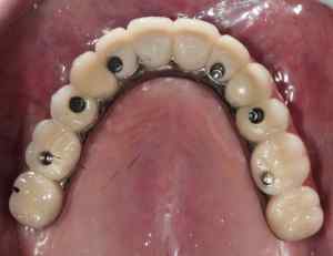 Dental Implants in Upper Jaw