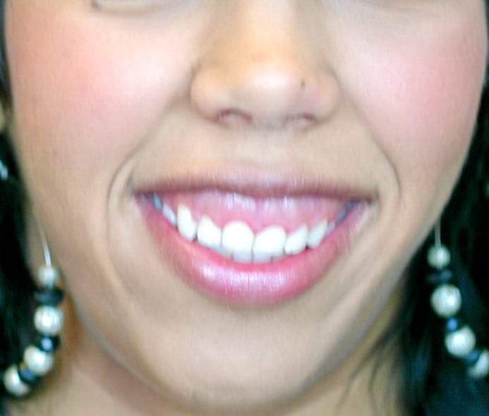 Smile Before Aesthetic Crown Lengthening of the upper teeth, and Lip Repositioning procedure