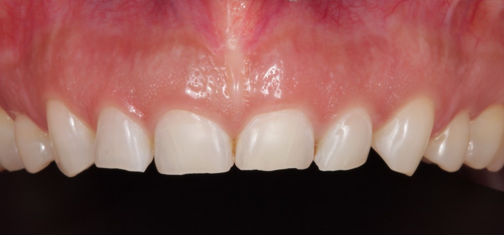 Case 2: Before Crown Lengthening, upper teeth