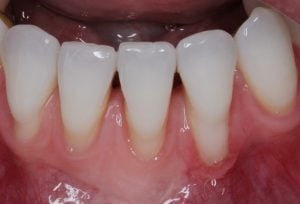 Before Gum Grafting on multiple teeth