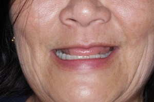 Patient's smile before all-on-five procedure