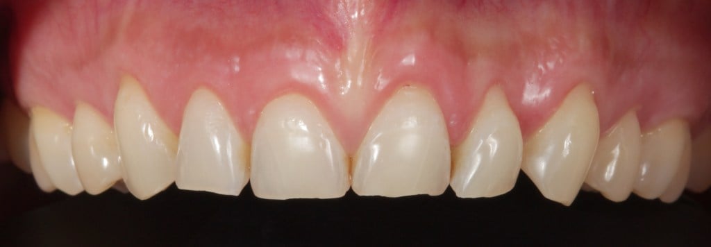 Case 2: After Crown Lengthening, upper teeth