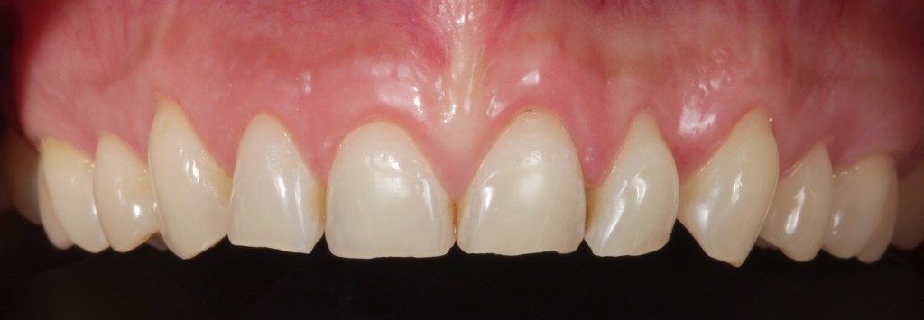 Case 2: After Crown Lengthening, upper teeth