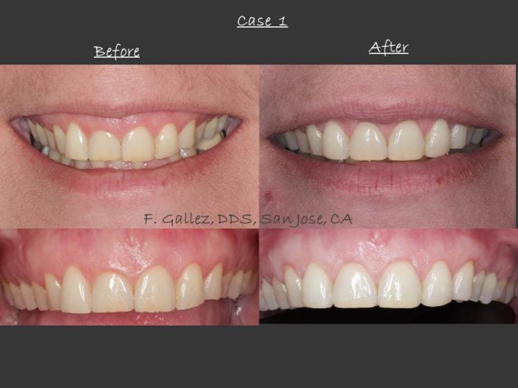 Case 1: Before and After Crown Lengthening performed by Dr. Gallez