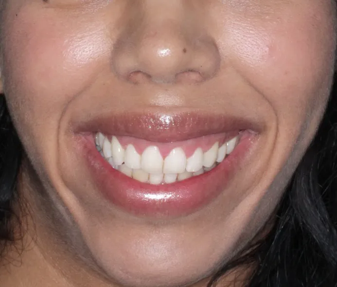 Smile After Aesthetic Crown Lengthening of the upper teeth, and Lip Repositioning procedure