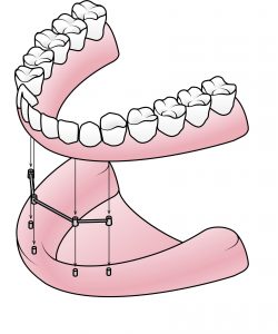diagram of a bar attachment denture